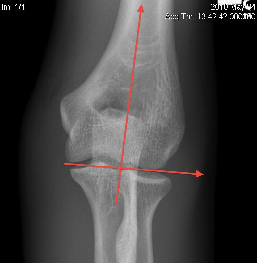 Elbow Normal AP 4 degrees valgus